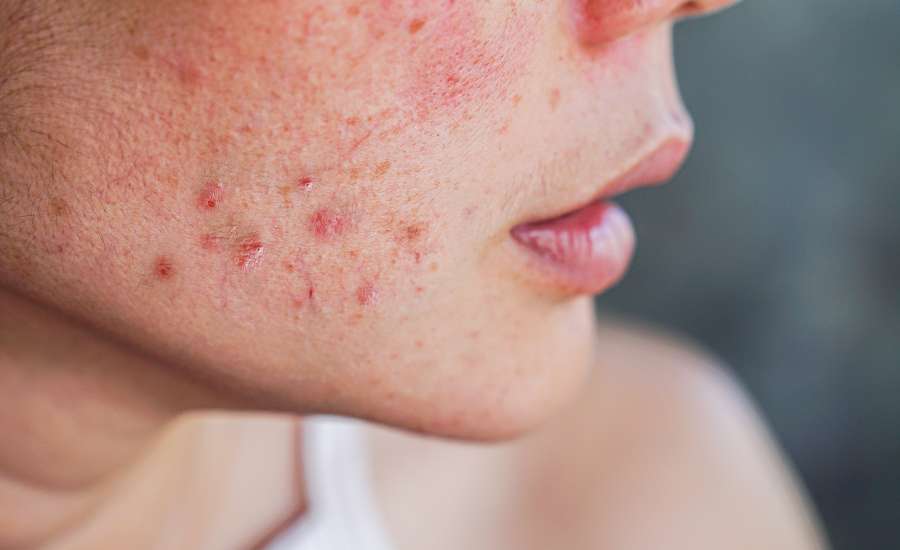 Le CBD calme l’inflammation à l’origine de l’acné.